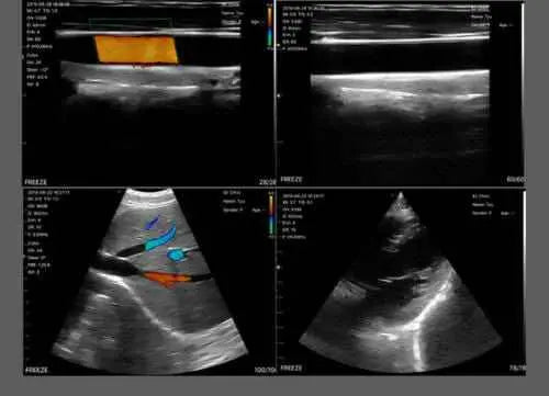 Portable Ultrasound Scanner with Wireless Probe for Easy Diagnostics